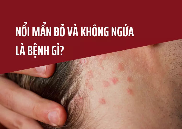Nổi chấm đỏ trên da và không ngứa là dấu hiệu của bệnh gì?